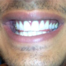”Mijn tanden waren bijna té wit”
